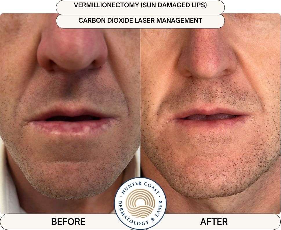 Actinic Cheilitis (Sun Damaged Lips) Treatment